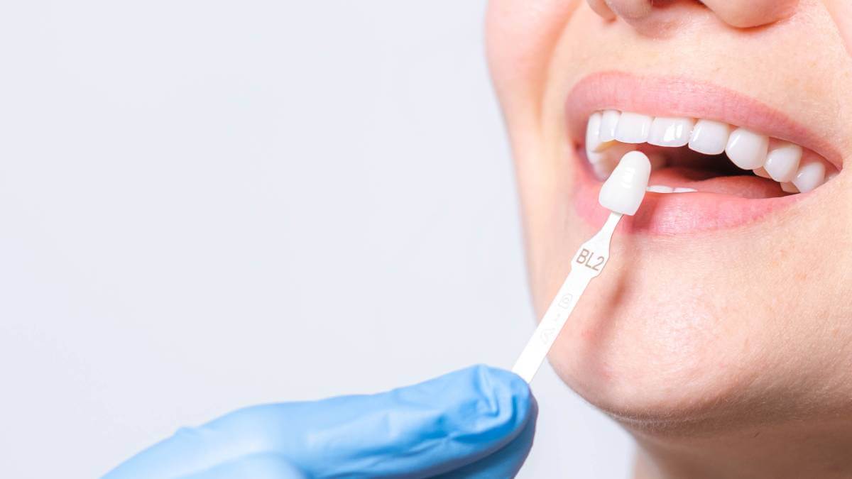 veneer model held up to smile