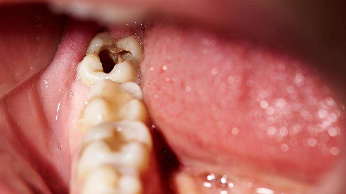 tooth-decay
